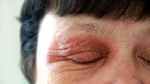 Plíseň kolem očí: příčiny a účinná léčba