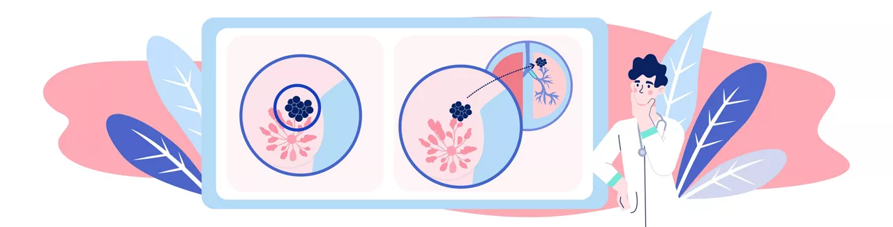 Ilustrace rozšíření rakovinných buněk do jiného orgánu – metastázy