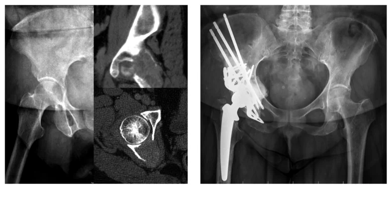 Rozšířené metastázy v kyčelní kosti před a po operaci s implantací