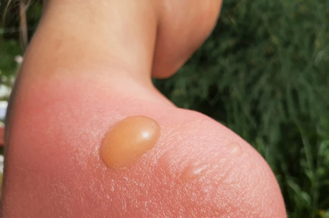 Vážné popálení sluncem s bublinou na kůži